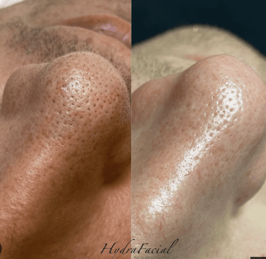 HydraFacial device in use on skin