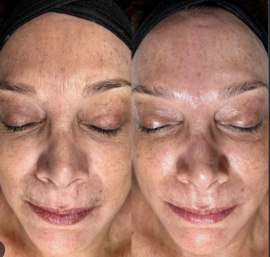 hydrating serum being infused during HydraFacial treatment