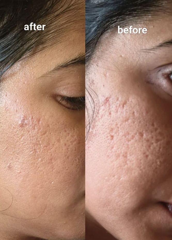 Refreshed skin post-treatment