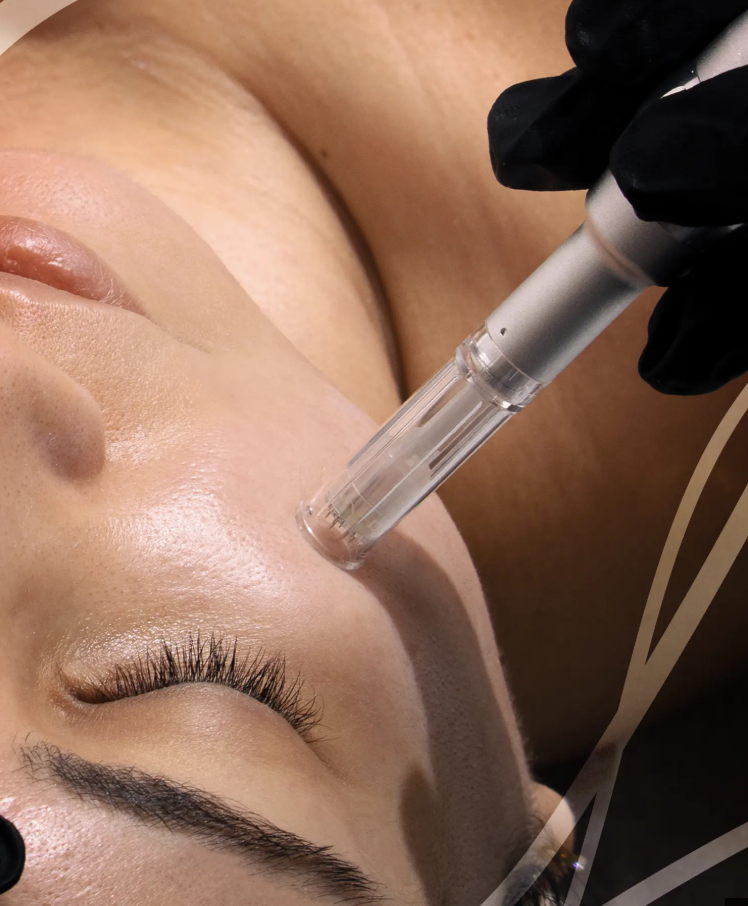 microneedling treatment being performed at Lioréa Lounge