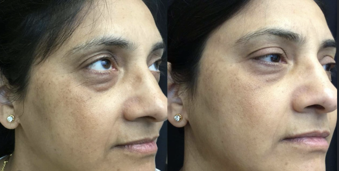 skin preparation before microneedling treatment