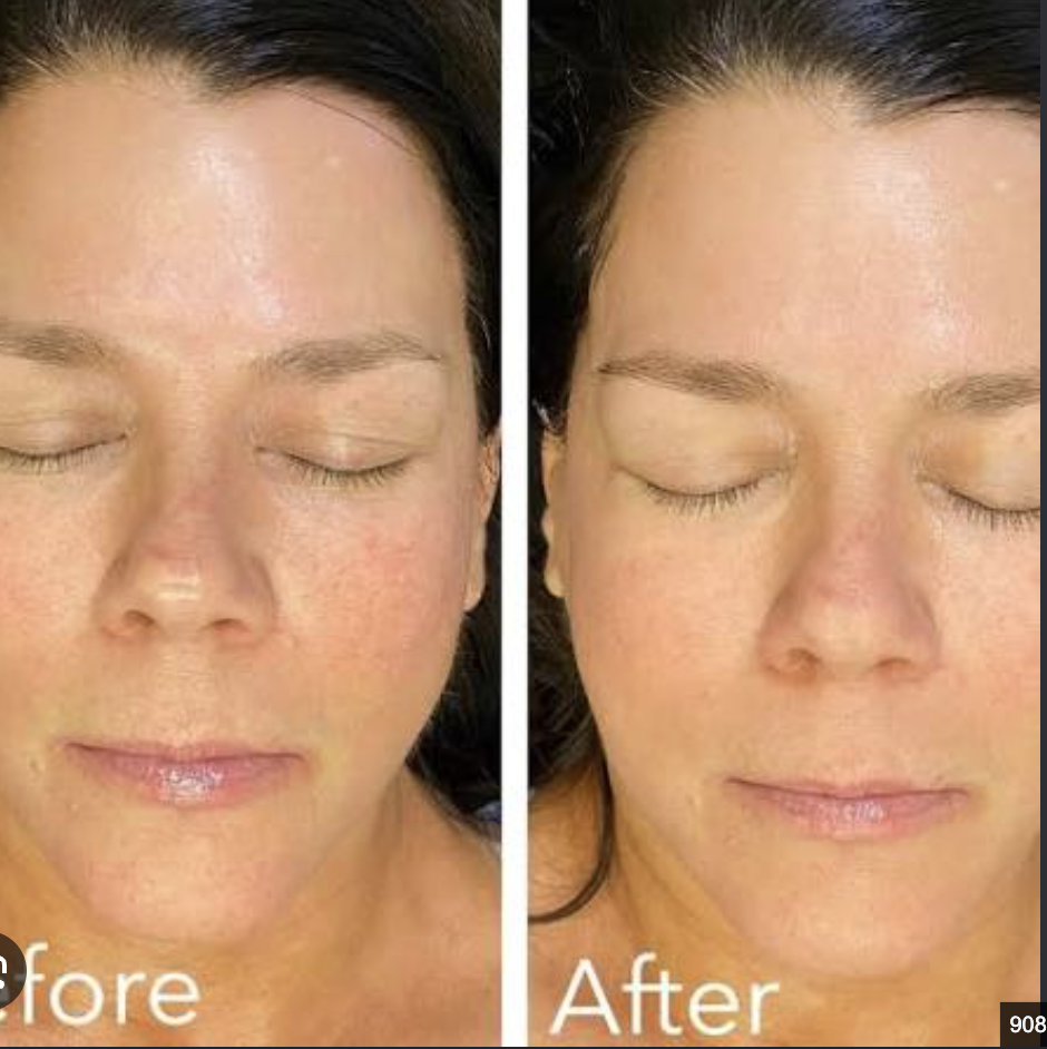 Oxygenating gel application close-up